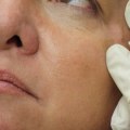 Can Estheticians Inject Botox in Georgia?